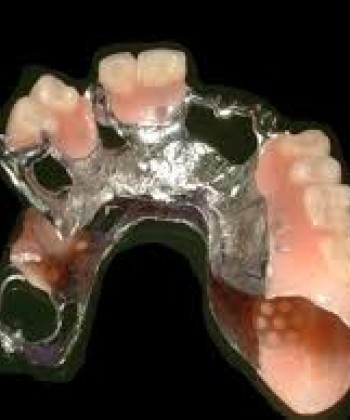 Metal partial Dentures – II