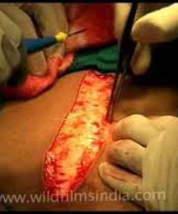 Abdominal Surgery 